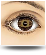 植入式鏡片固定於瞳孔中心