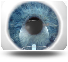 植入式微型鏡片植入眼內前房